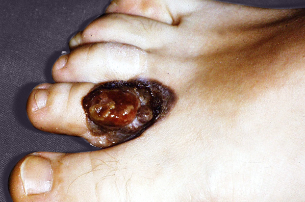Melanoma acrolentigginoso
